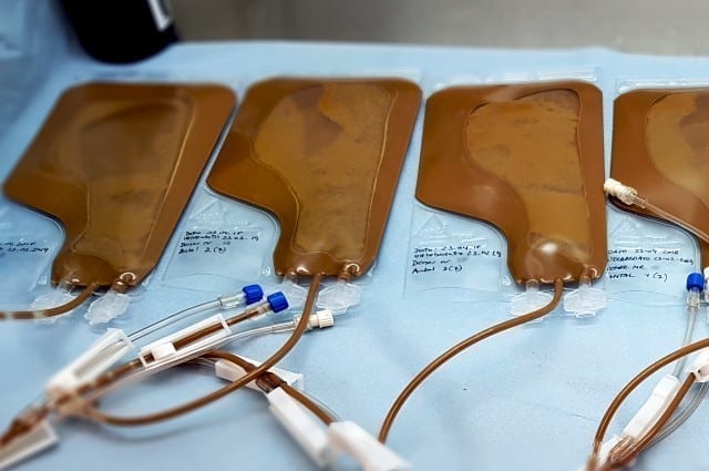 andres afføring redder liv ved at transplantere via transplantation